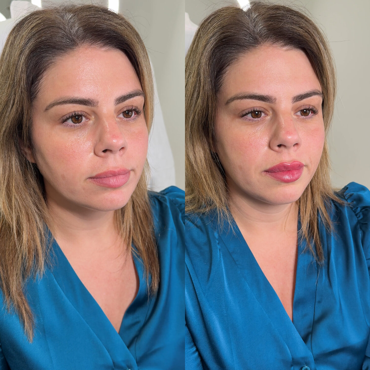 Before and after lip filler treatment