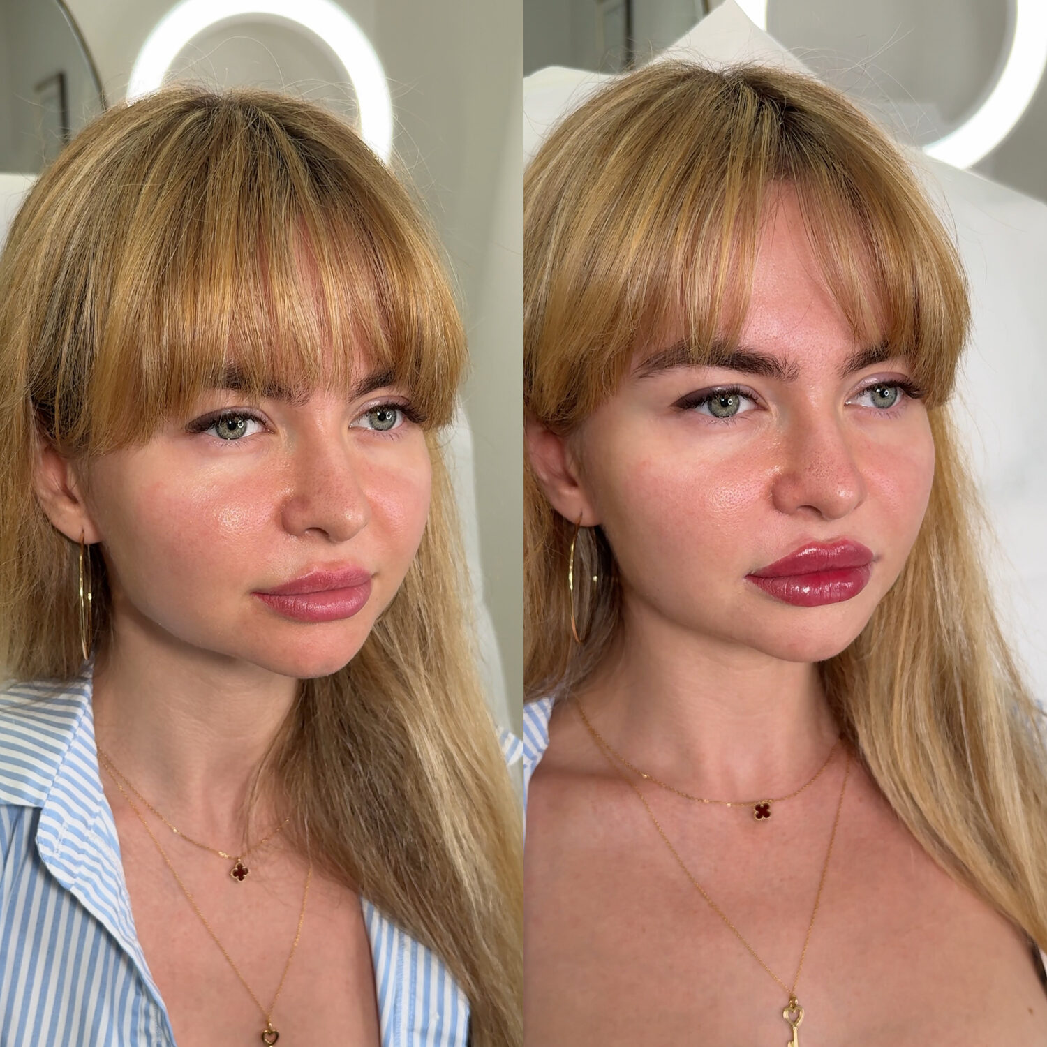 Before and after lip filler treatment using the Modlinska Method