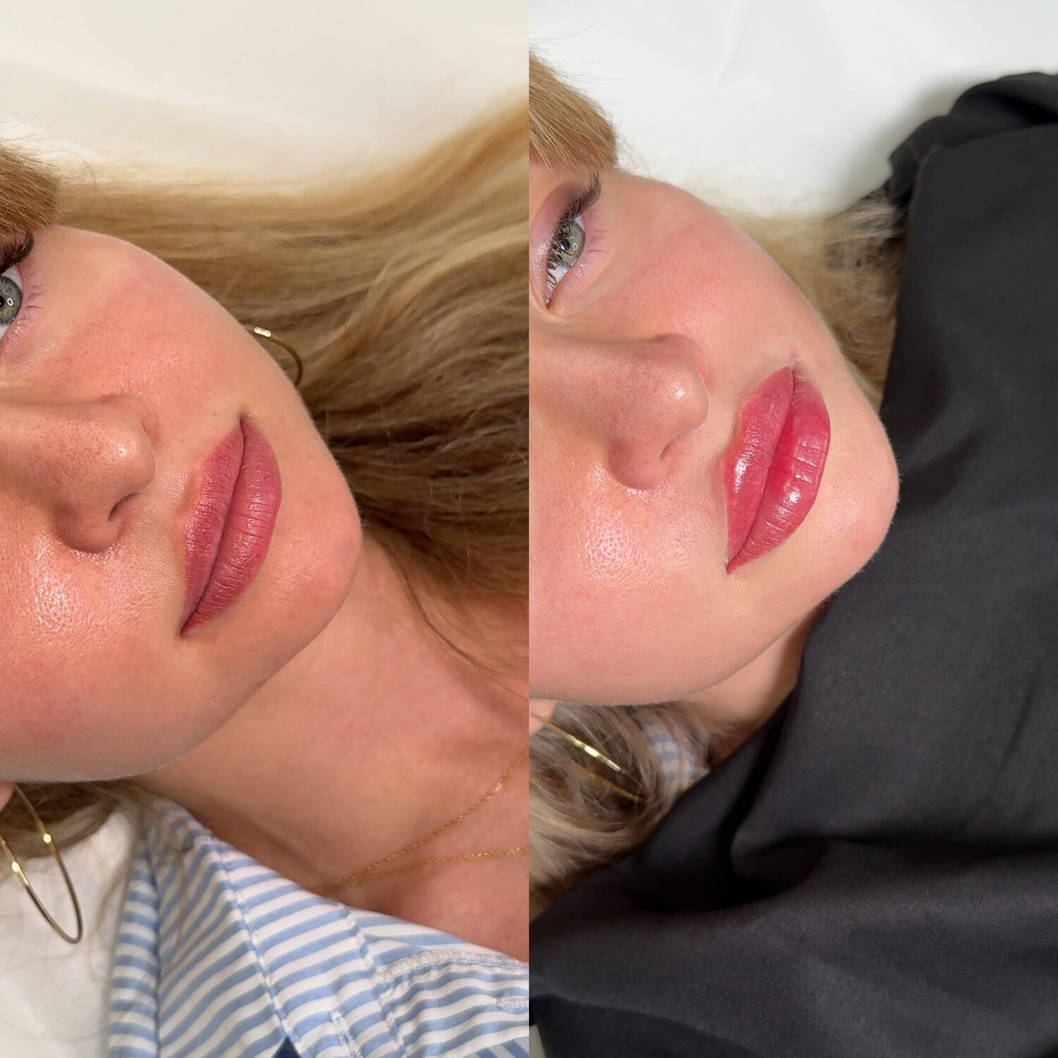 Before and after lip filler treatment, profile view