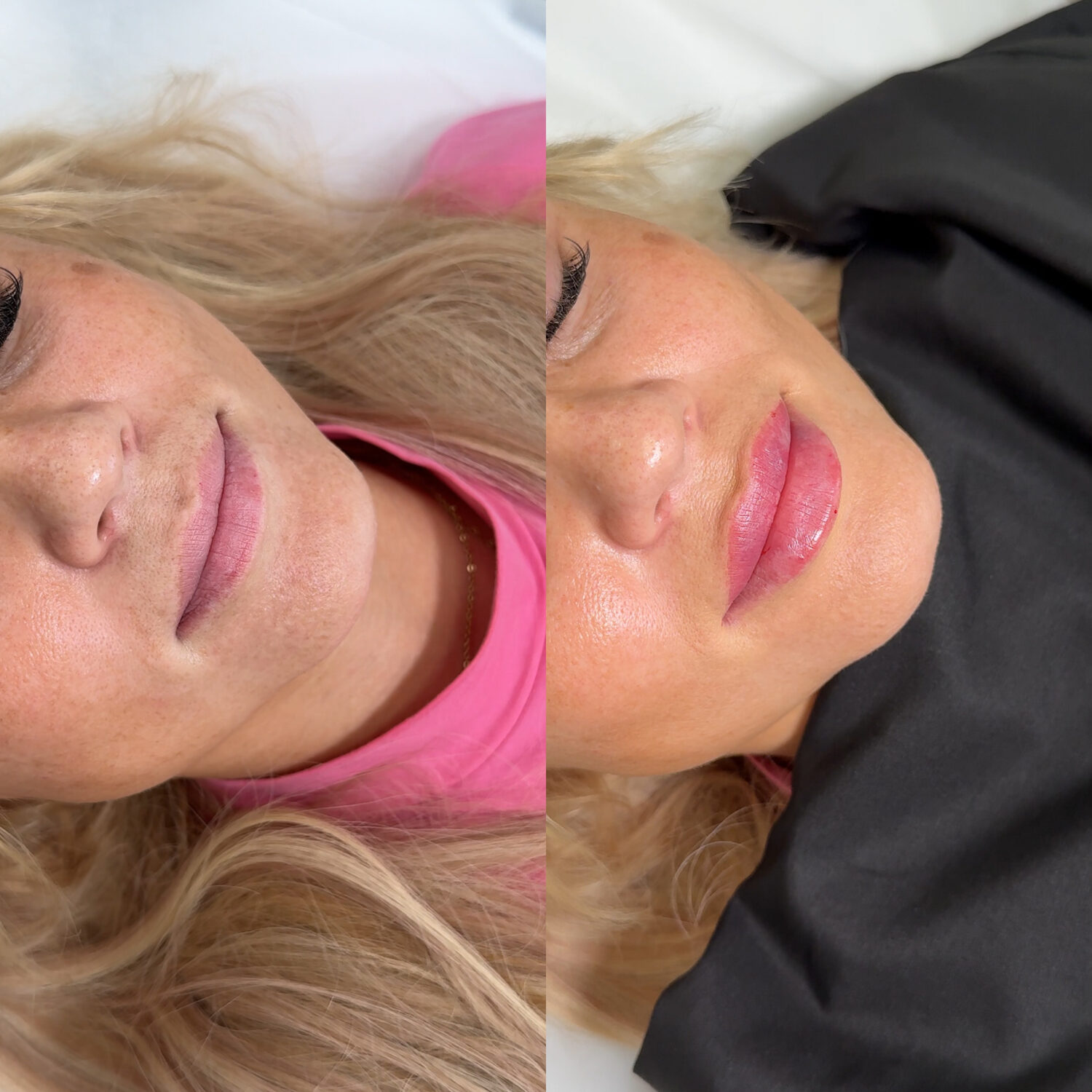 Before and after lip filler treatment, profile view