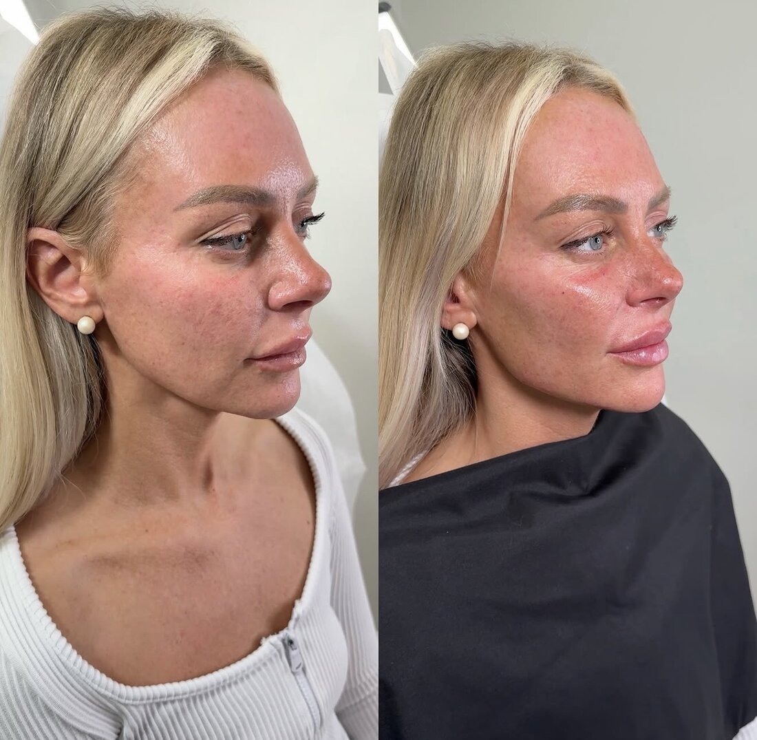 Before and after jawline filler result