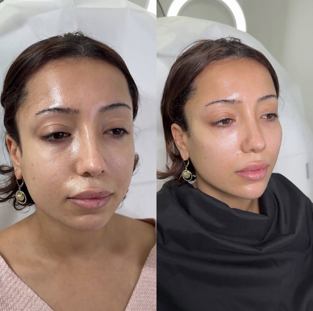 Before and after jawline filler result