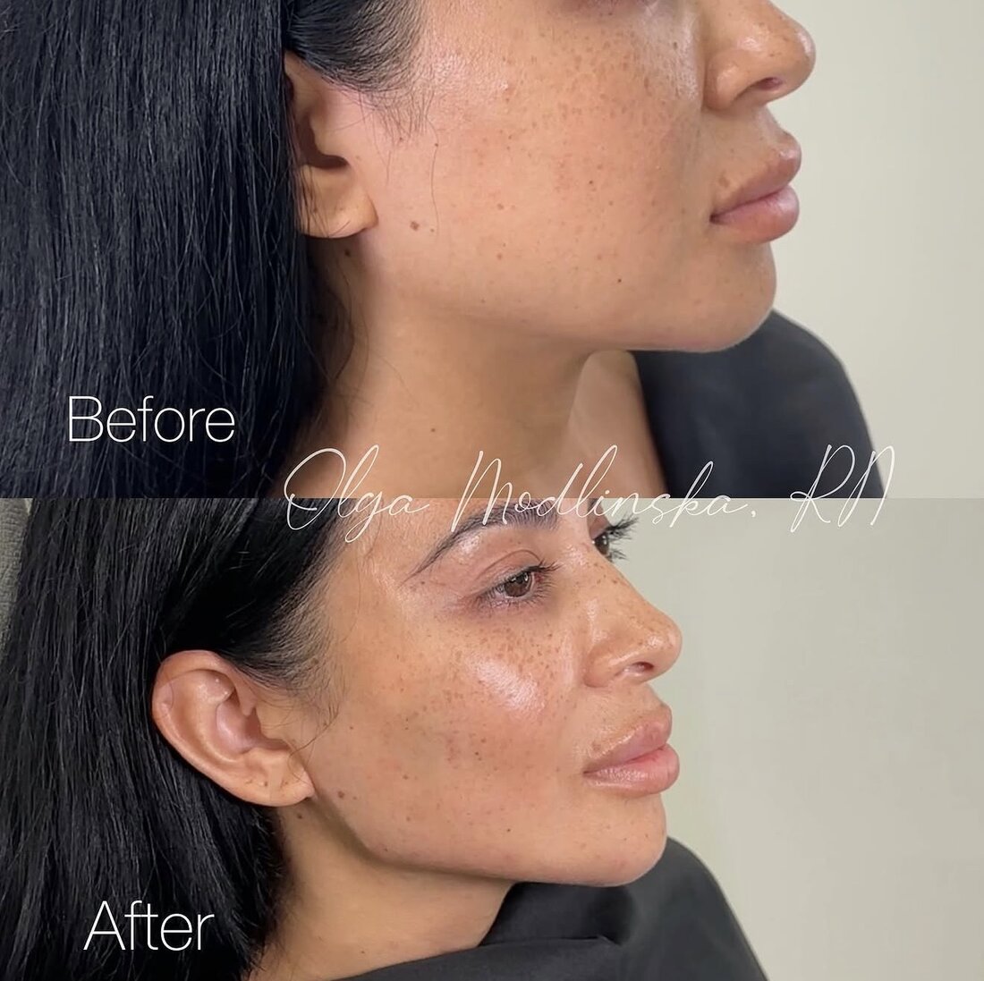 Before and after jawline filler result