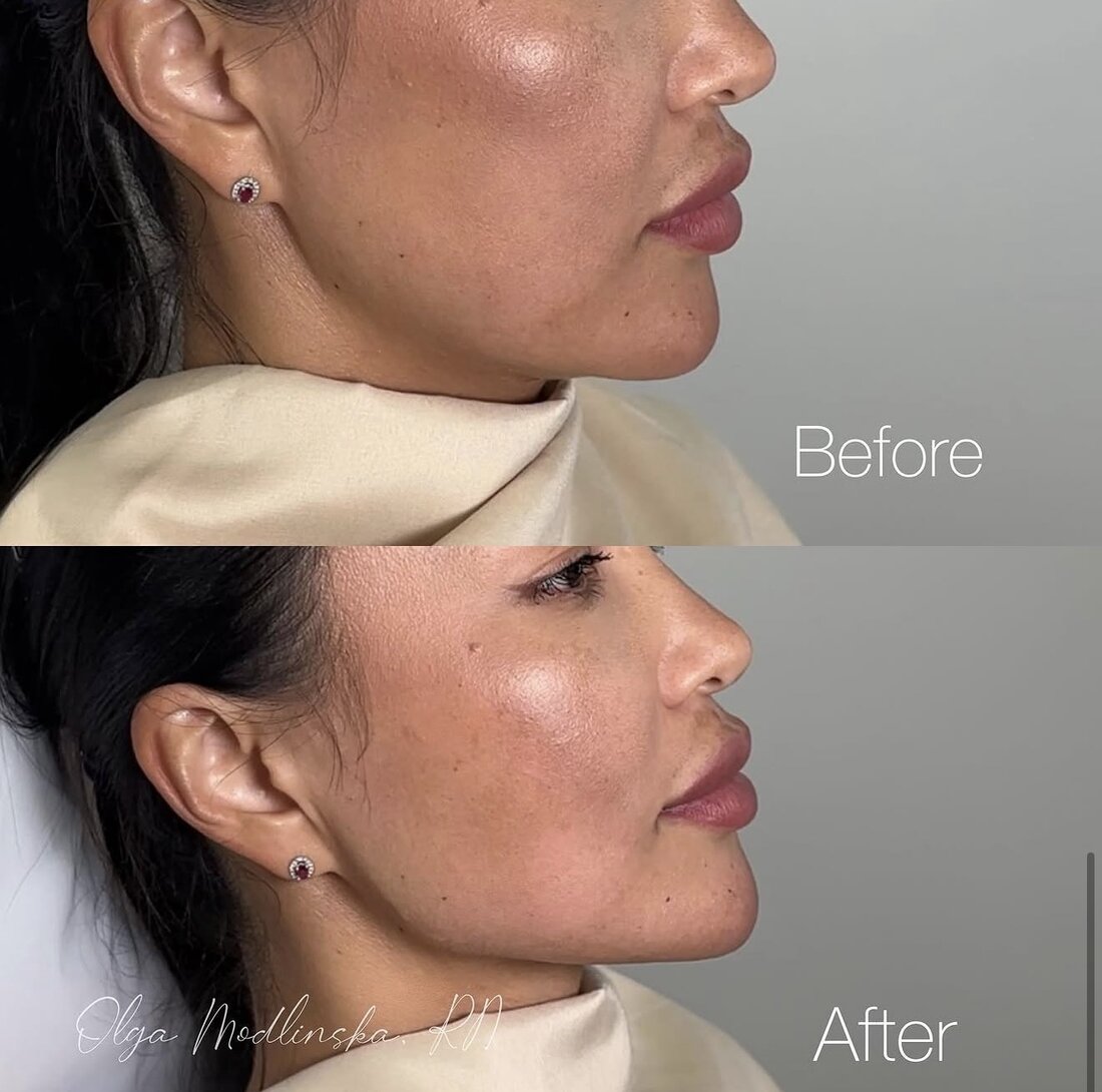 Before and after jawline filler result