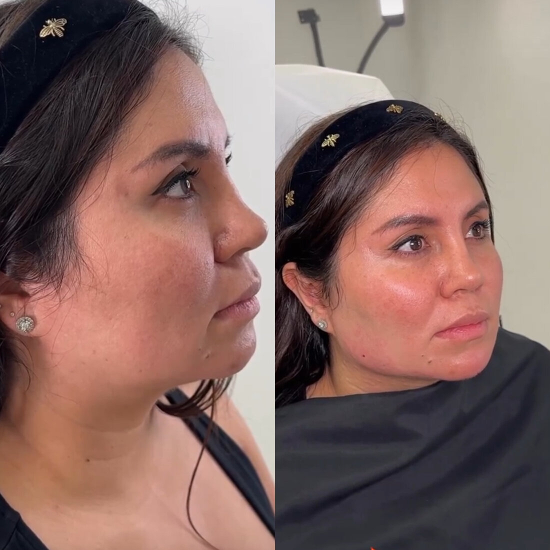 Before and after jawline filler result