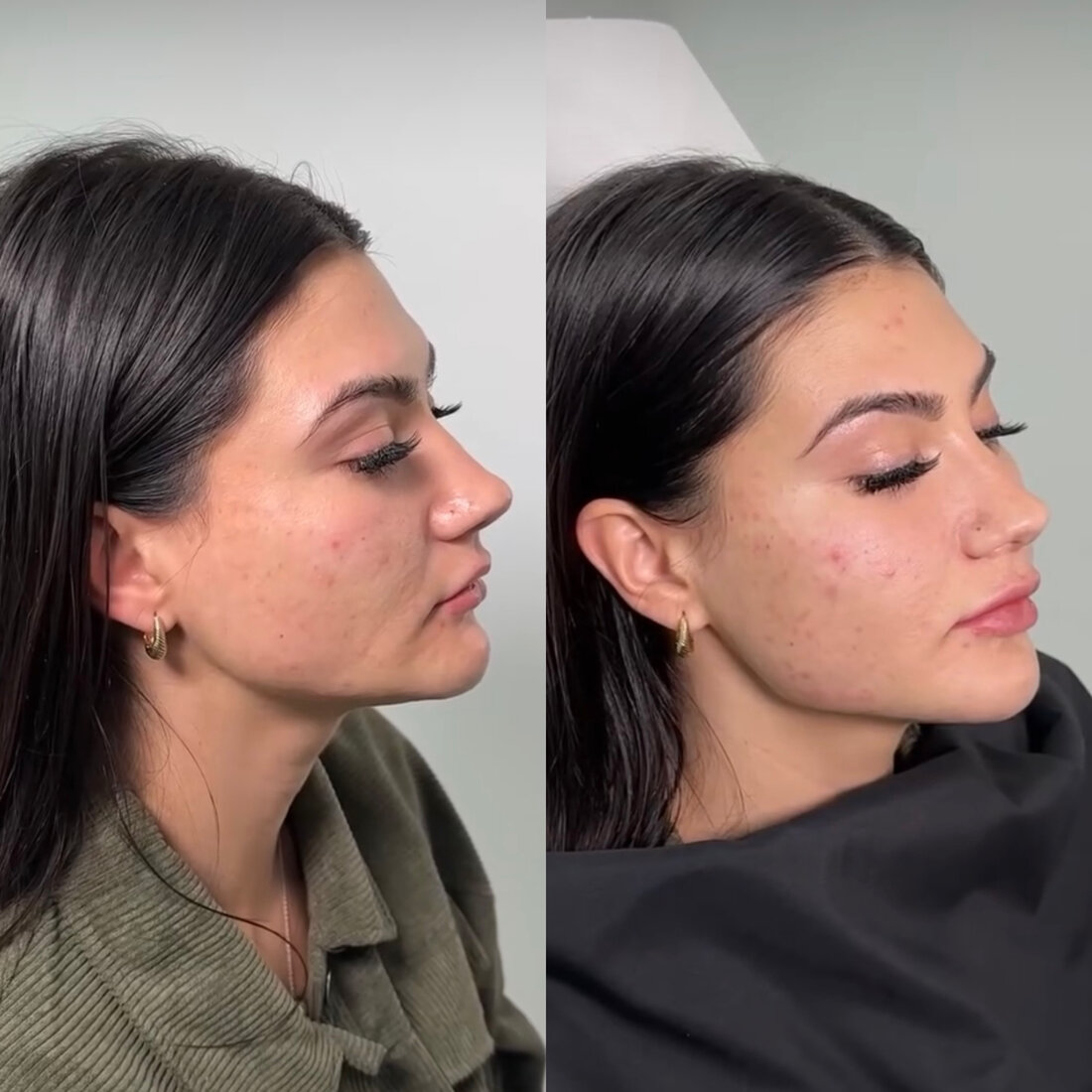 Before and after jawline filler result