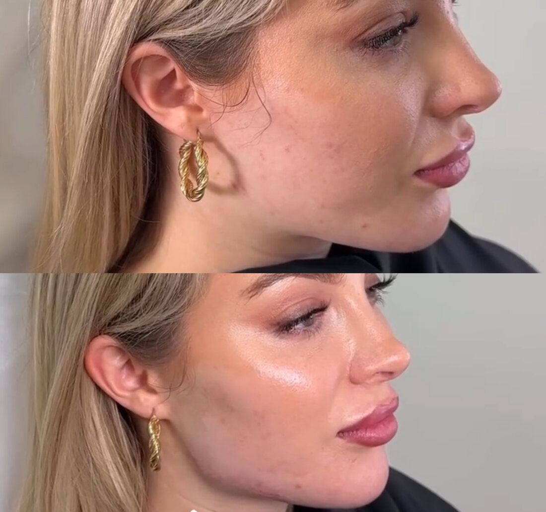 Before and after jawline filler result