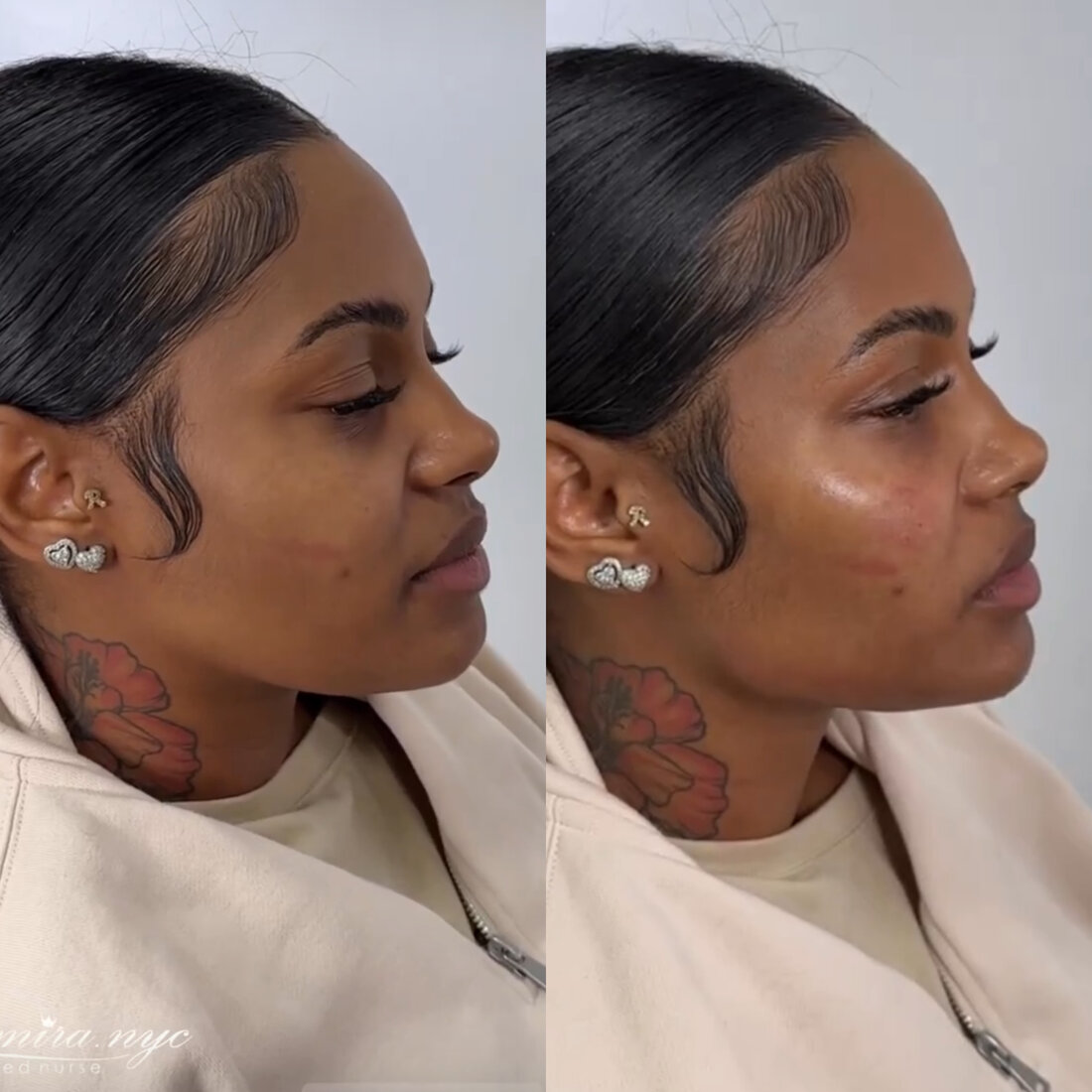 Before and after jawline filler result