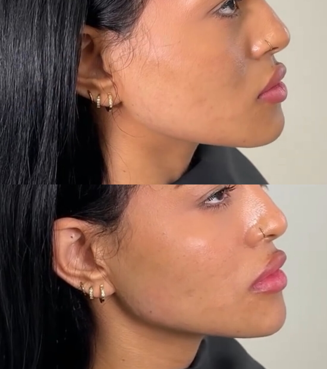 Before and after jawline filler result