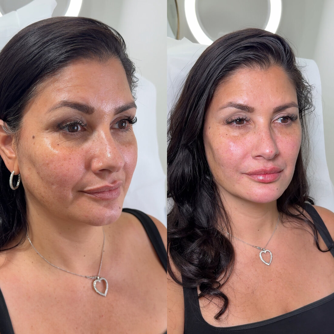 Before and after full face result