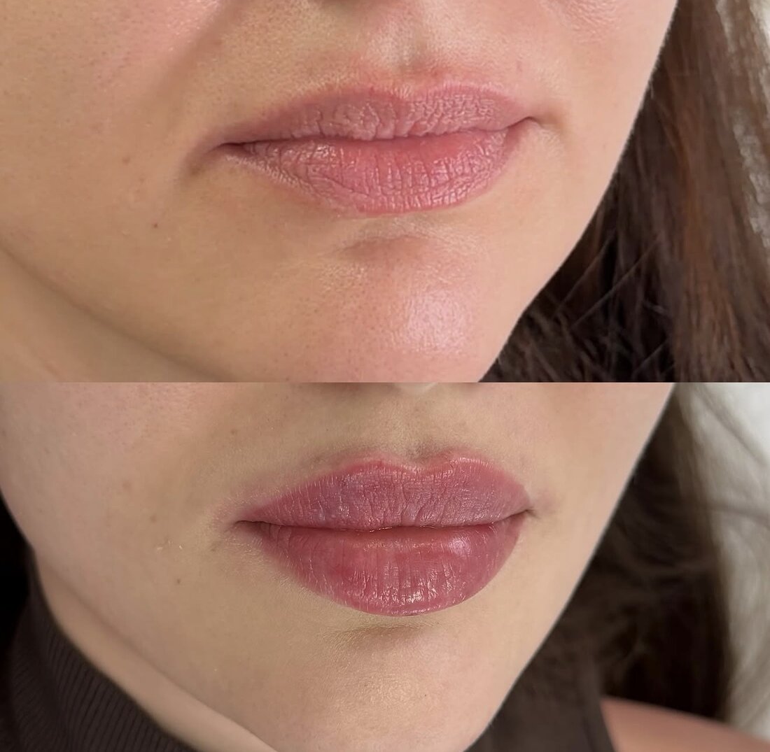 Before and after lip filler result