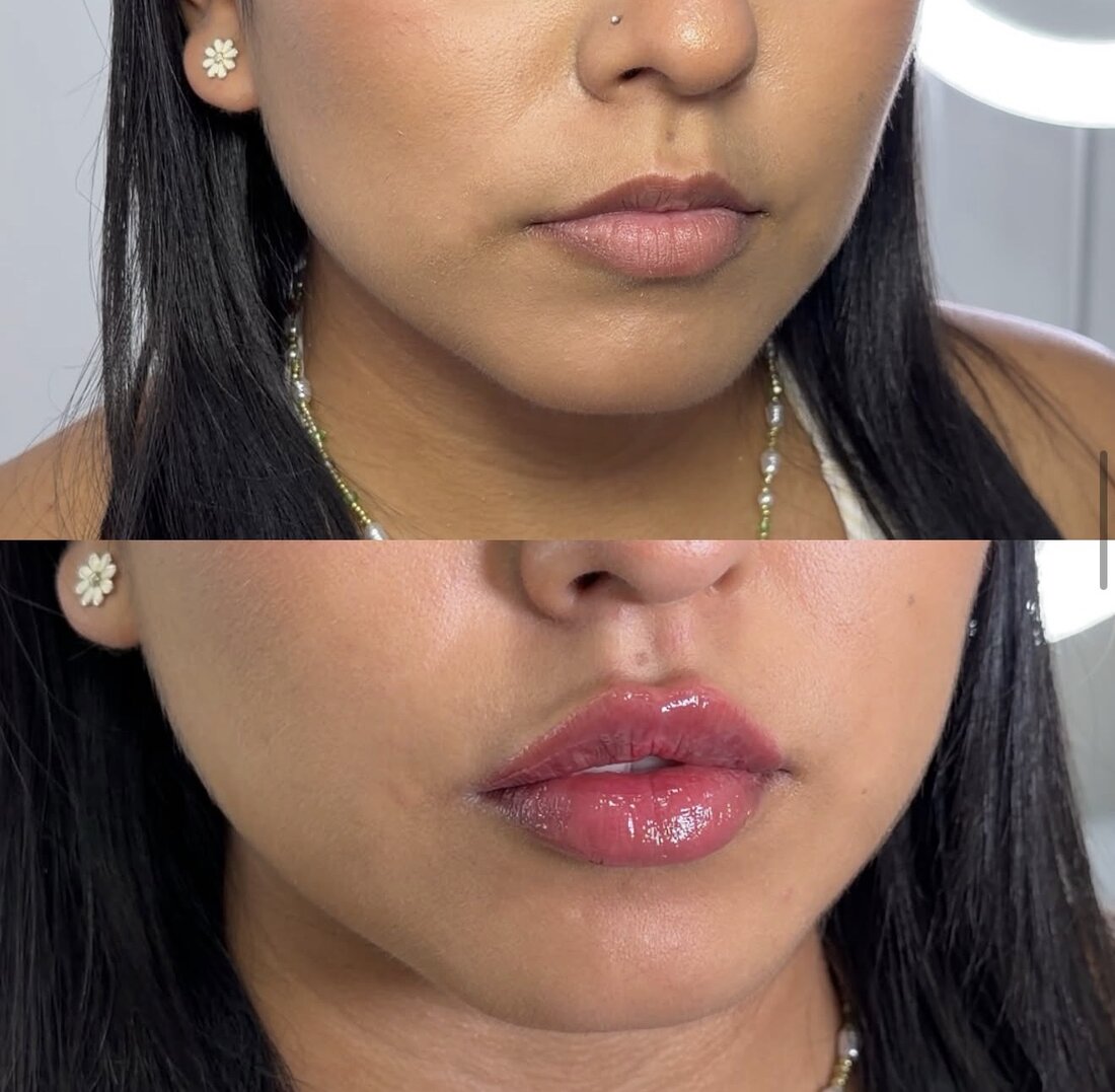Before and after lip filler result