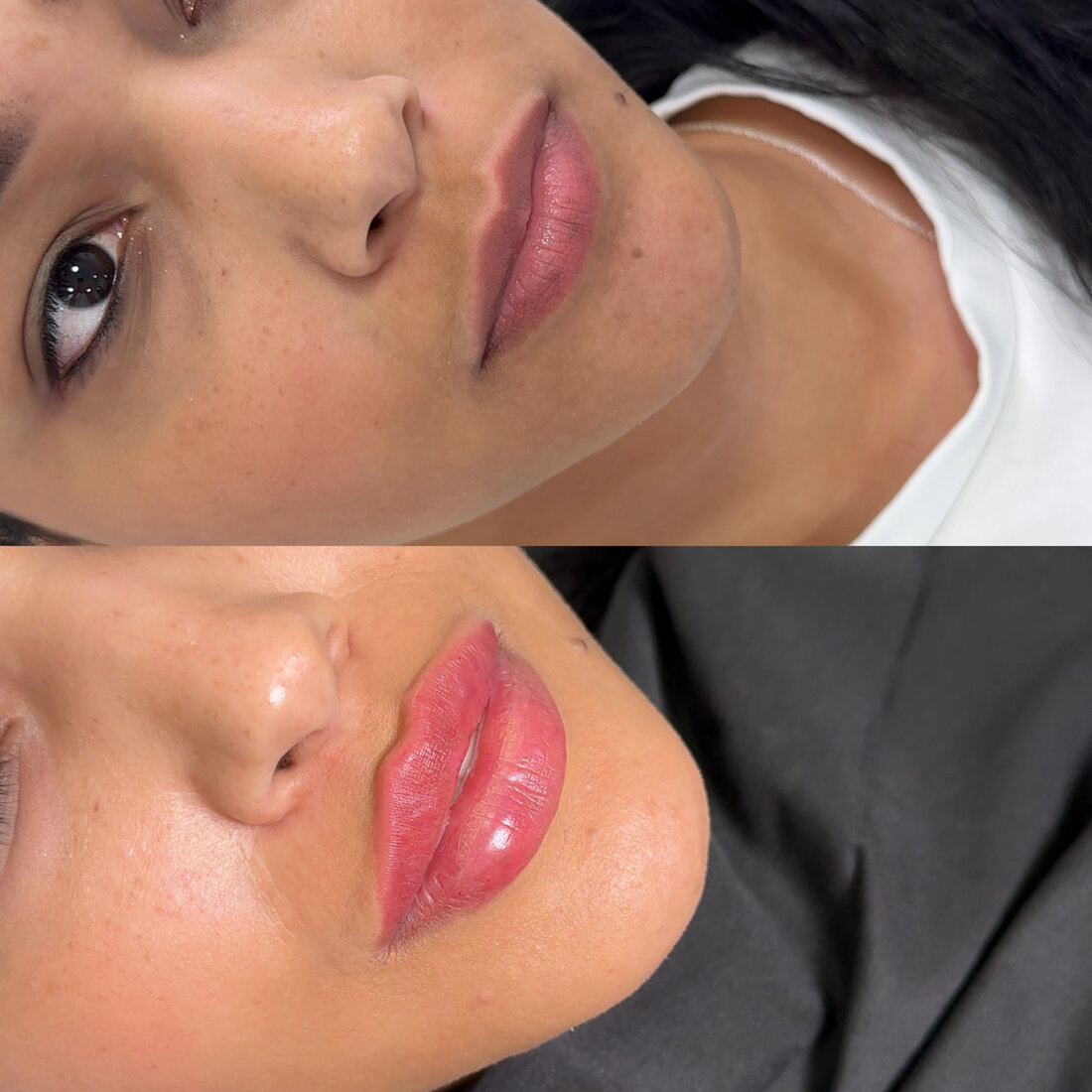 Before and after lip filler result