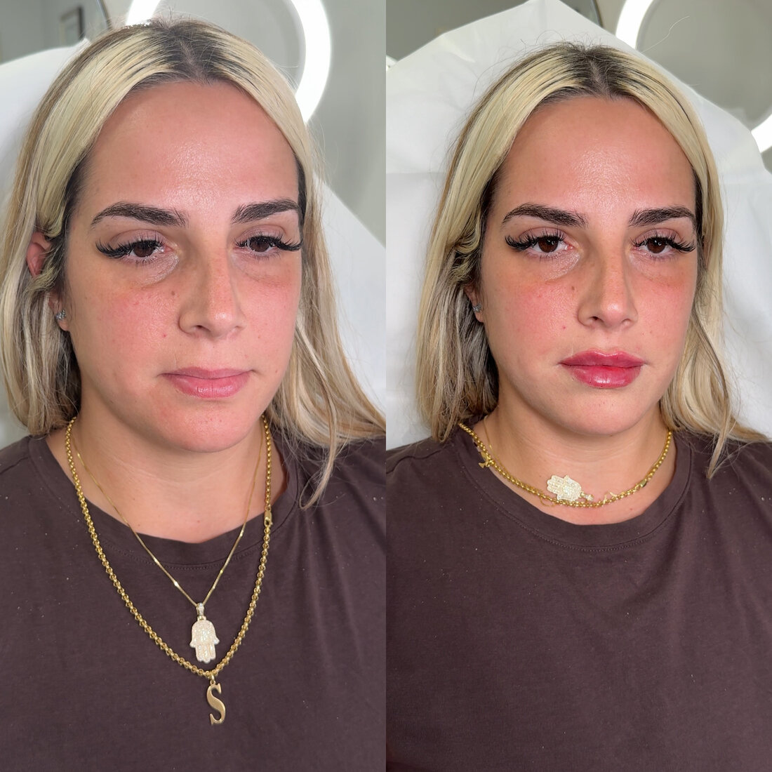 Before and after lip filler result