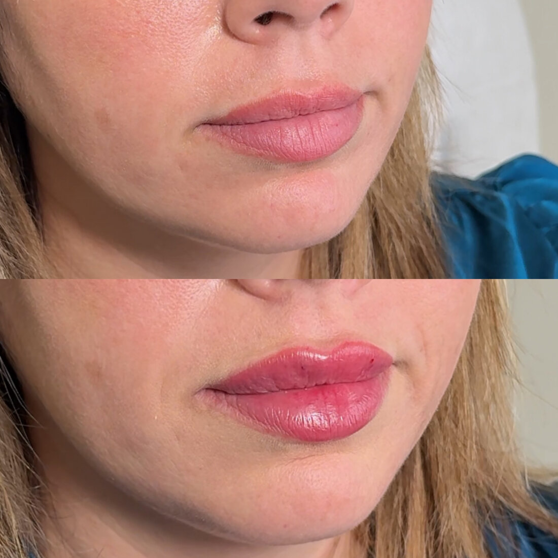 Before and after lip filler result