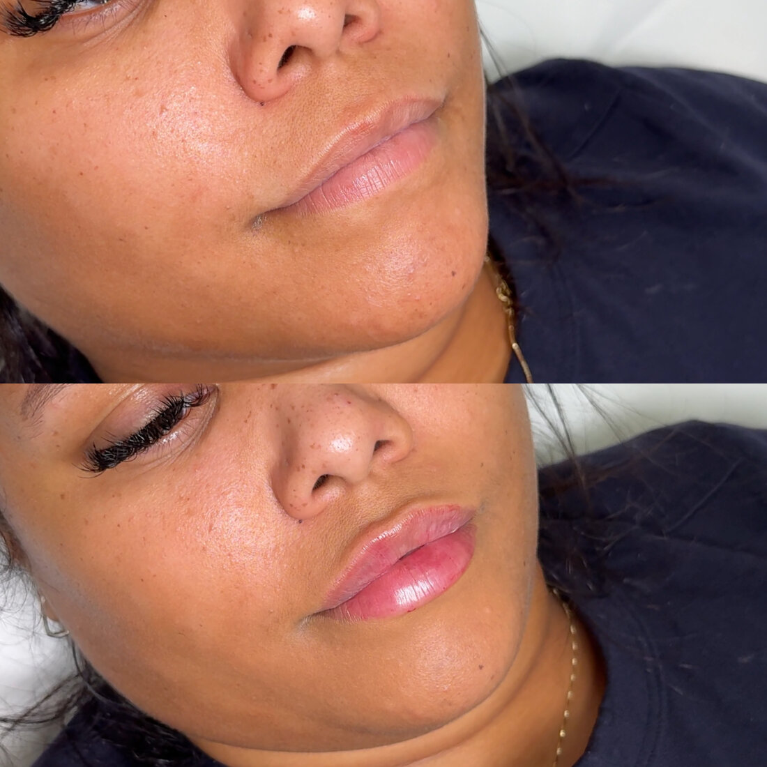 Before and after lip filler result