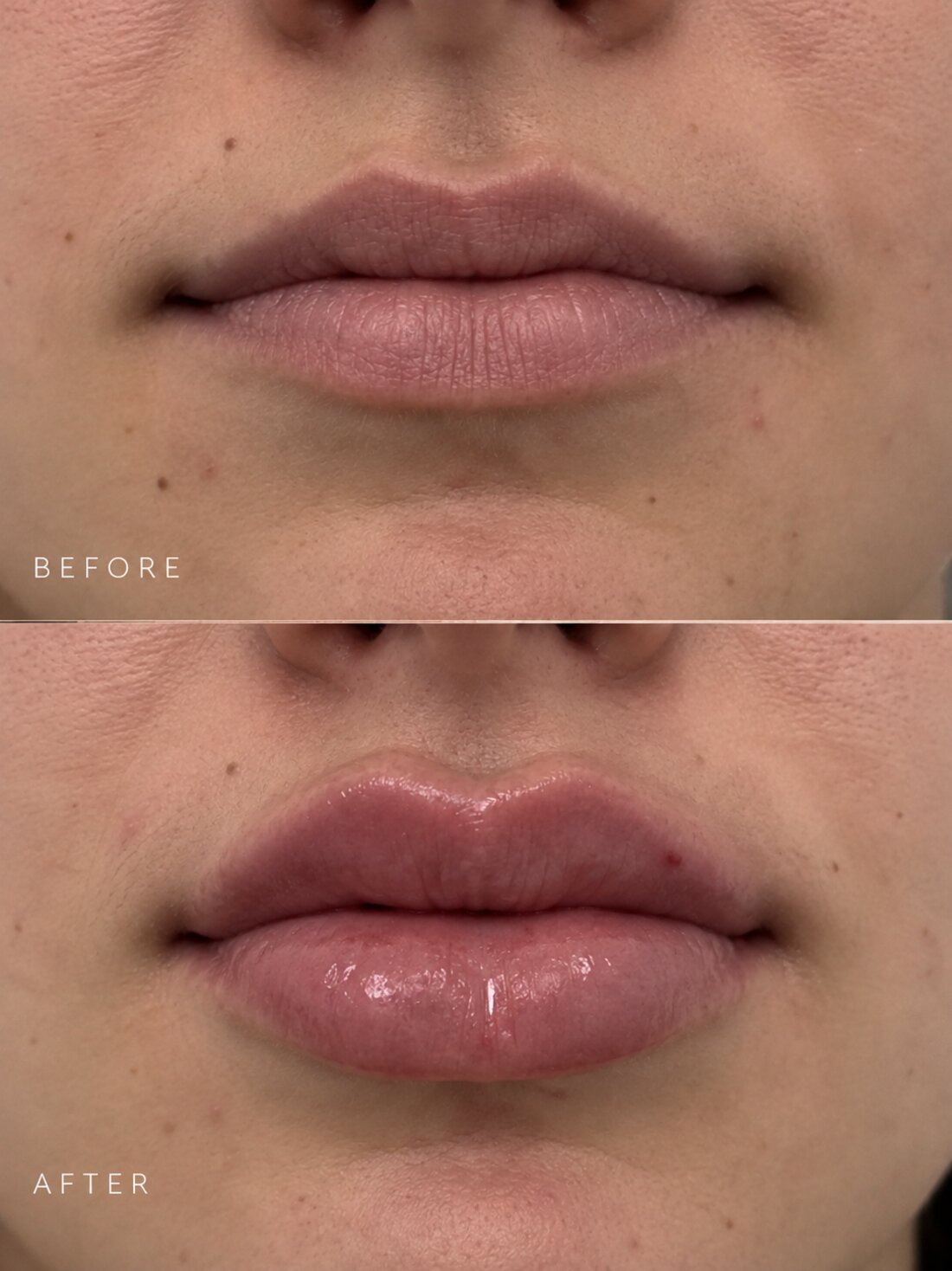 Lip filler result from another provider