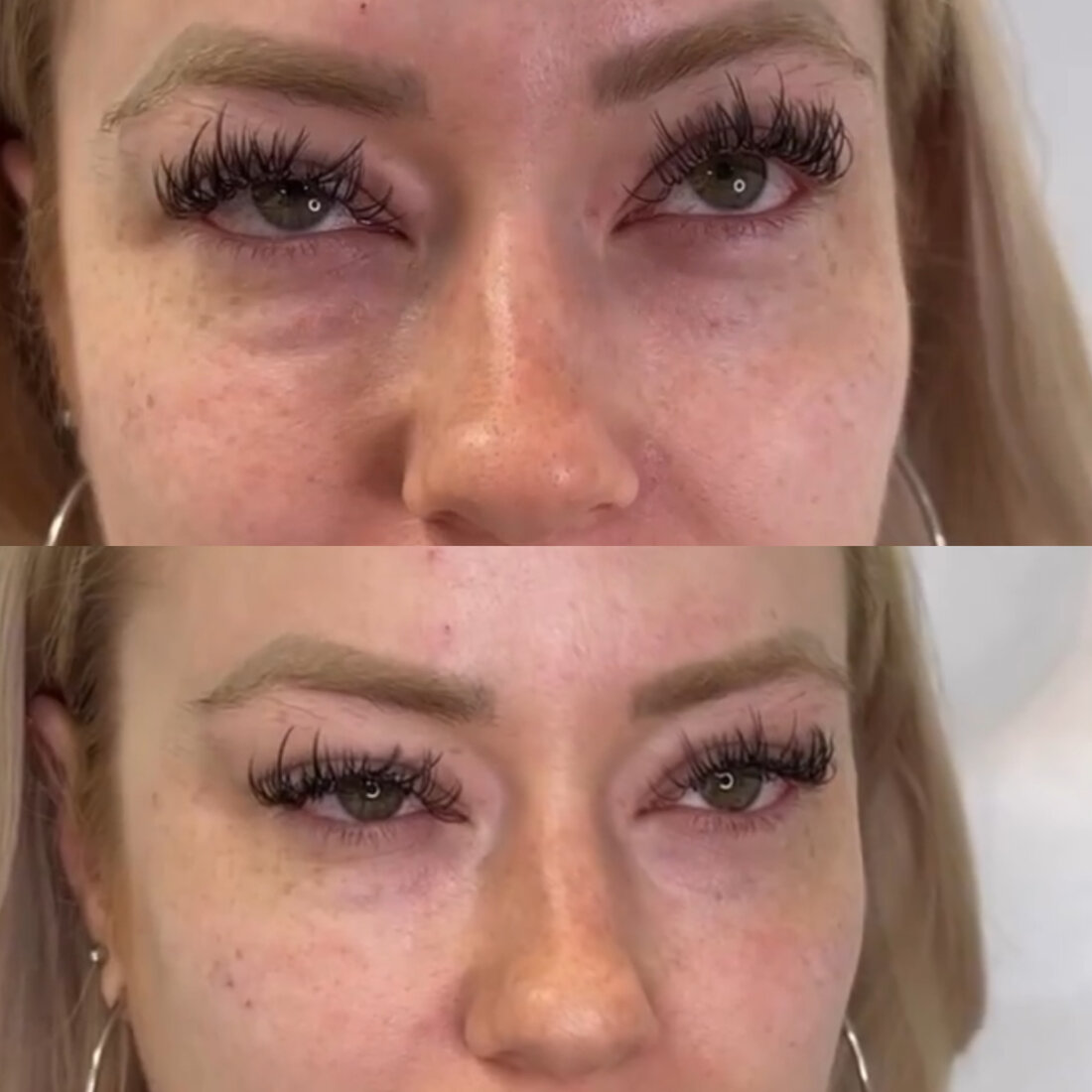 Before and after under eye filler result