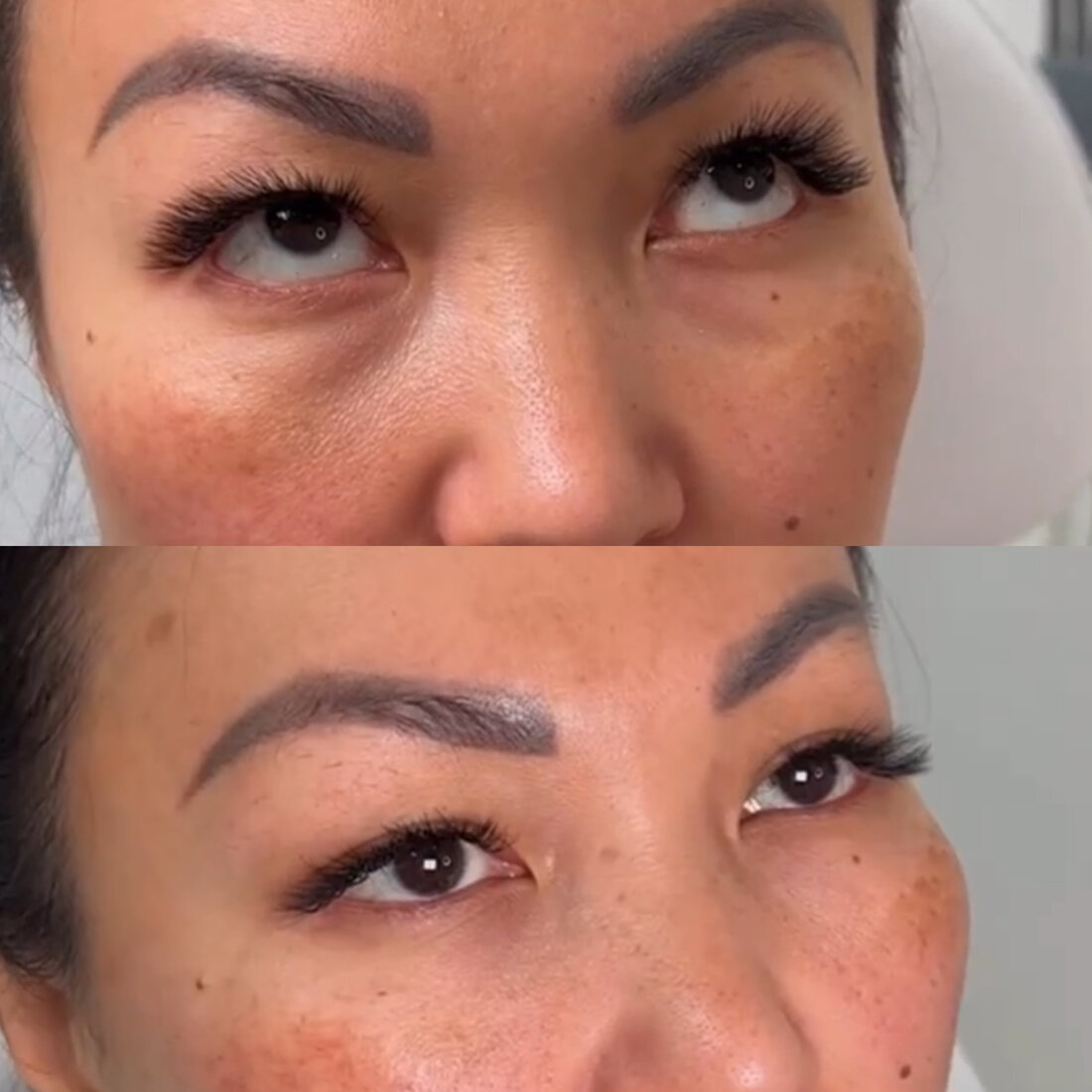 Before and after under eye filler result